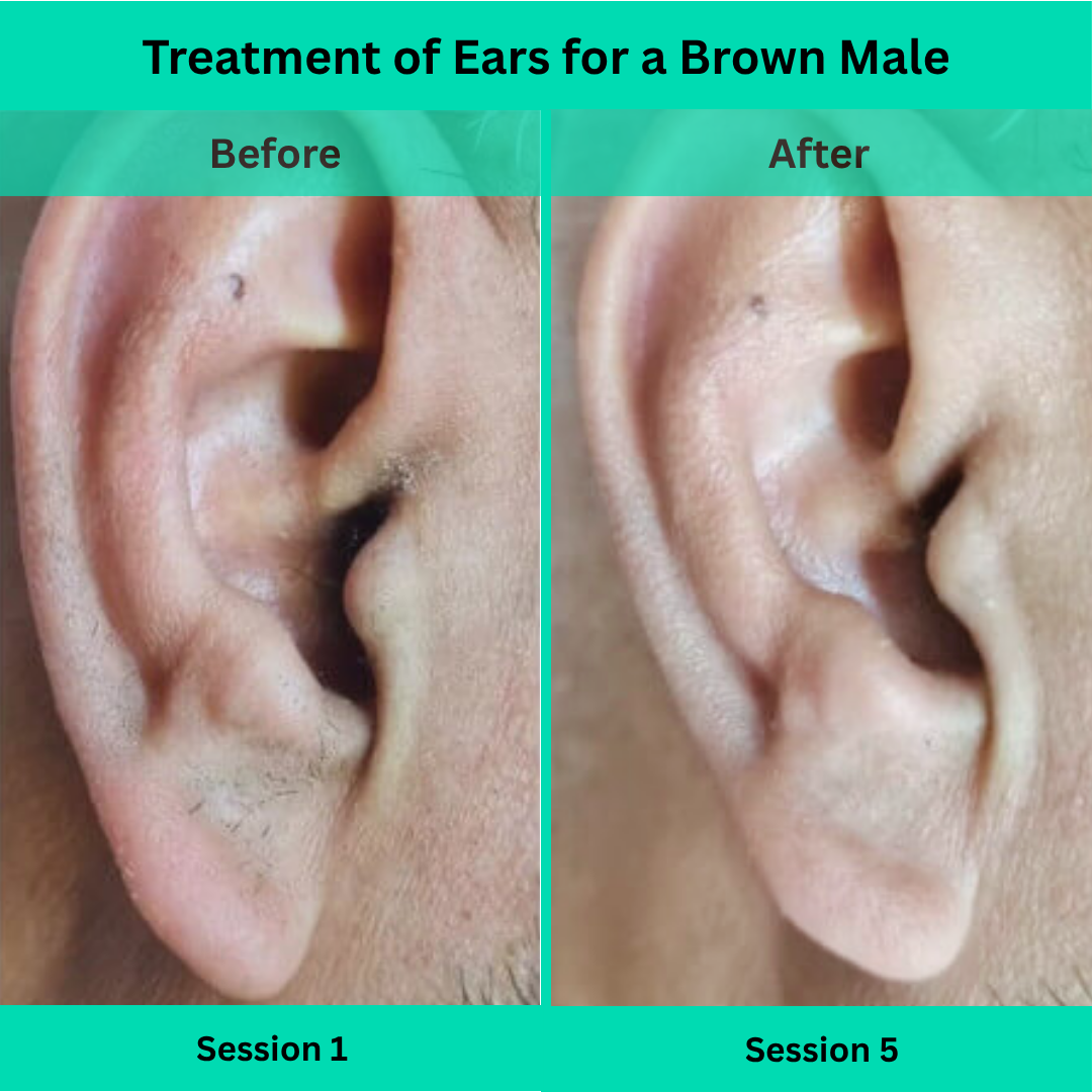 Before and After picture of Laser Hair Removal Treatment of Ears for a Male